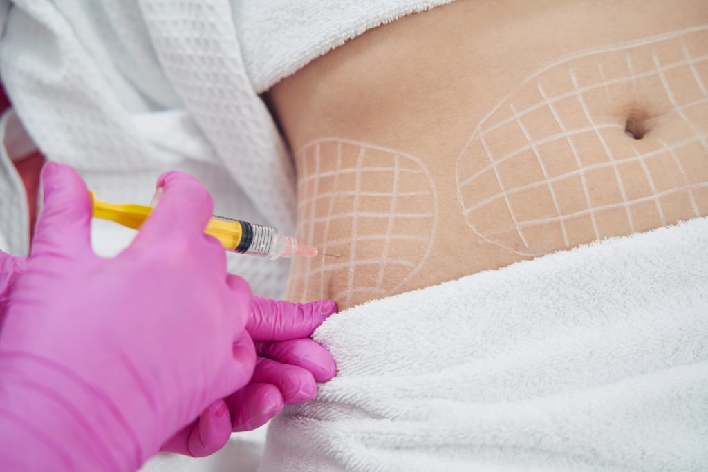 Overview of Fat Dissolving Treatments and Their Mechanisms