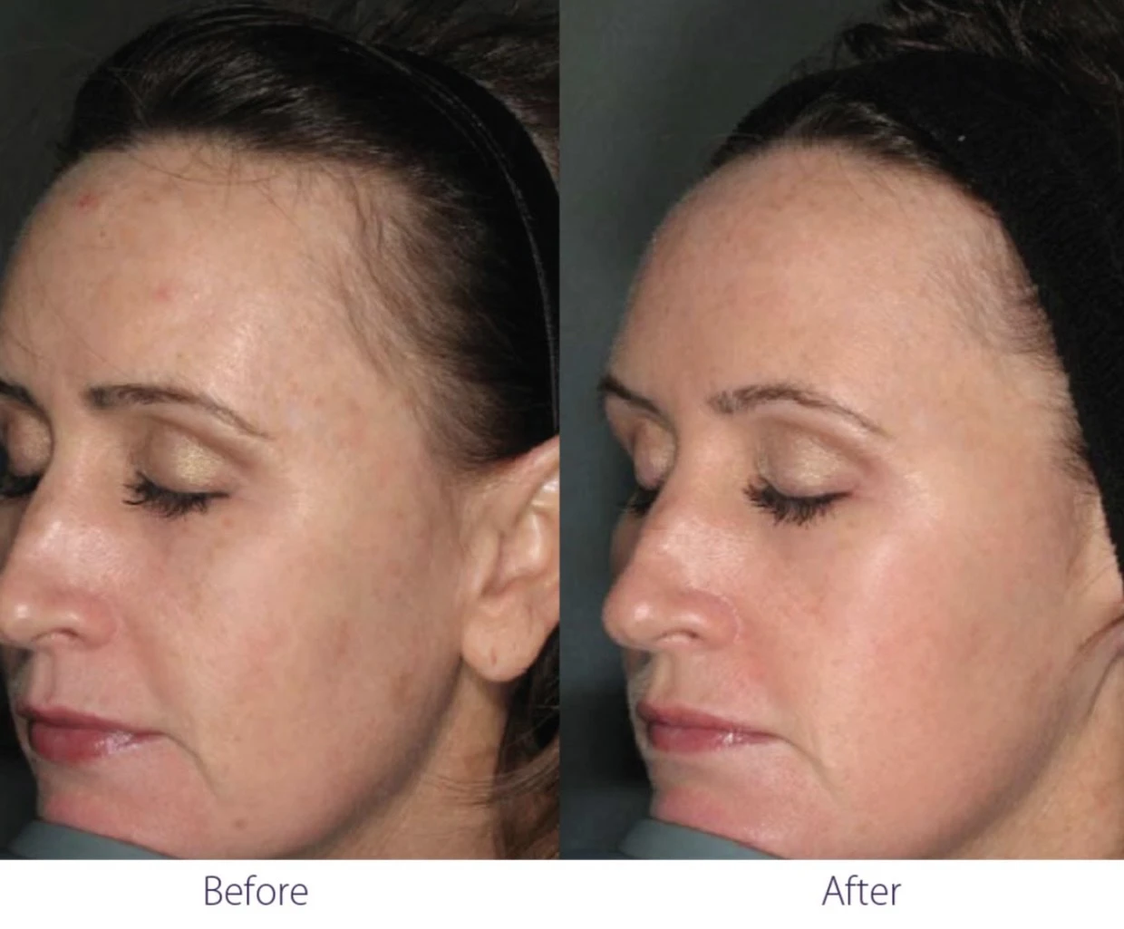 Clear Lift | Before and After Photo | Skinlogicx | Rego Park, NY