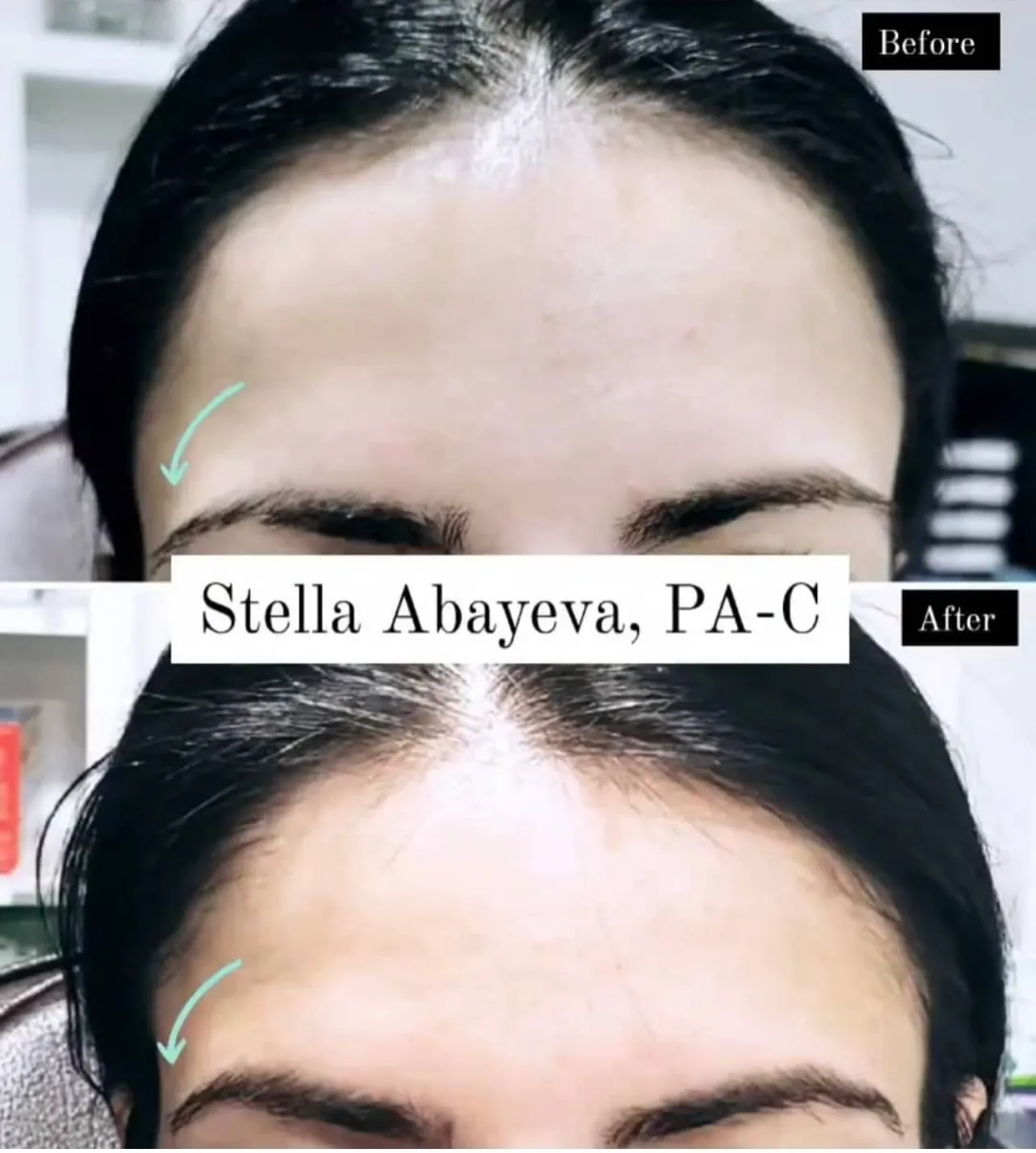 Eyebrow Lift | Before and After Photo | Skinlogicx | Rego Park, NY