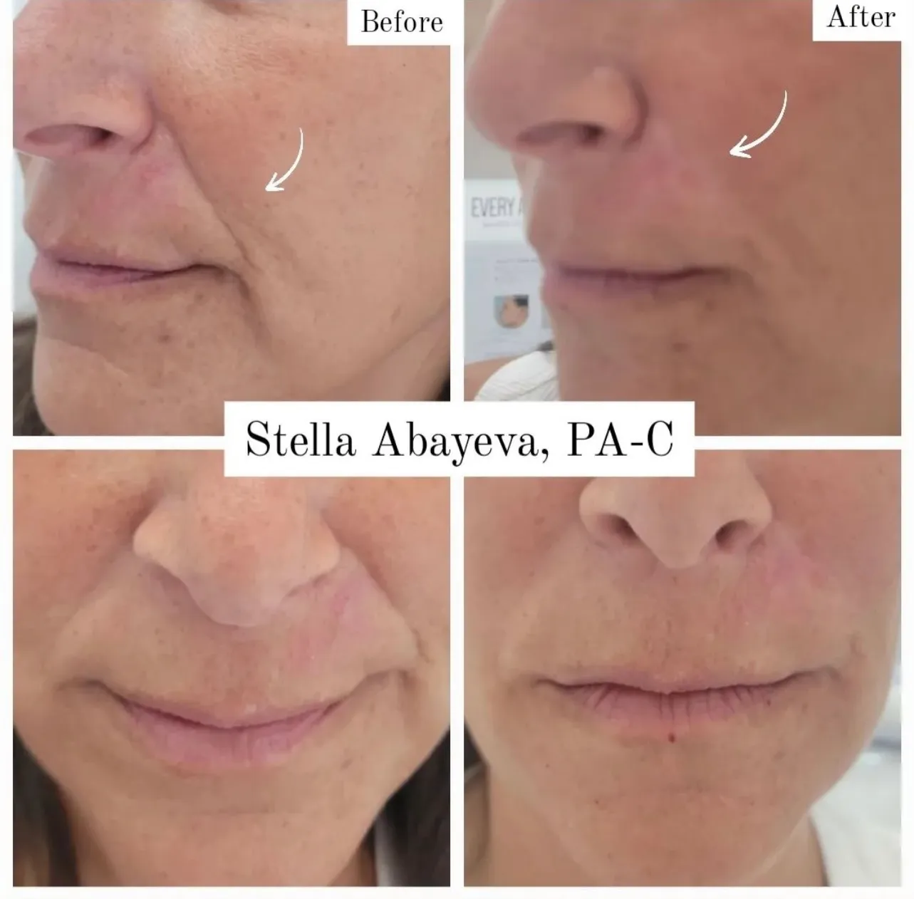 Nasolabial Line Correction Procedure | Before and After Photo | Skinlogicx | Rego Park, NY