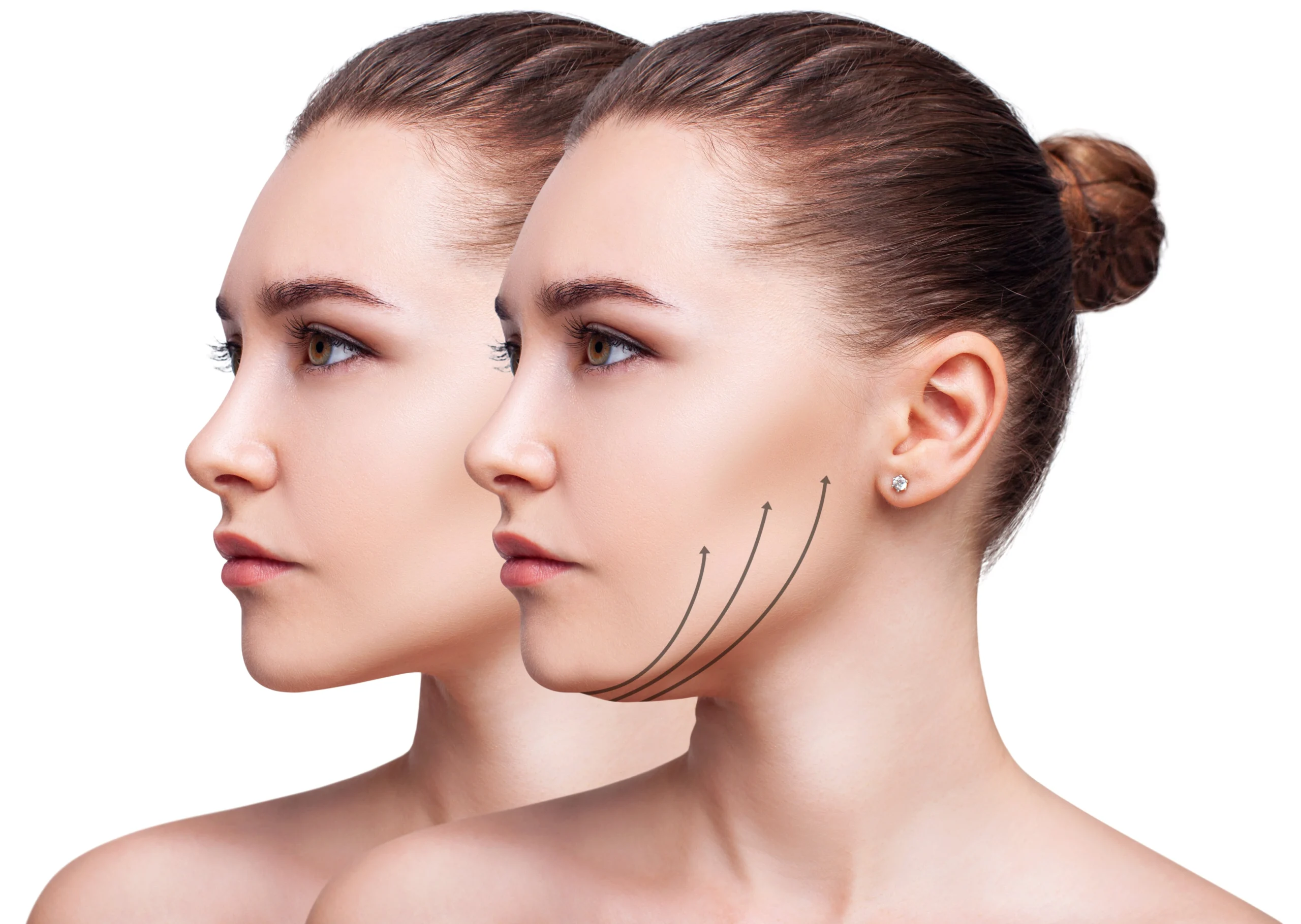 Woman chin fat removal | Skinlogicx | Rego Park, NY