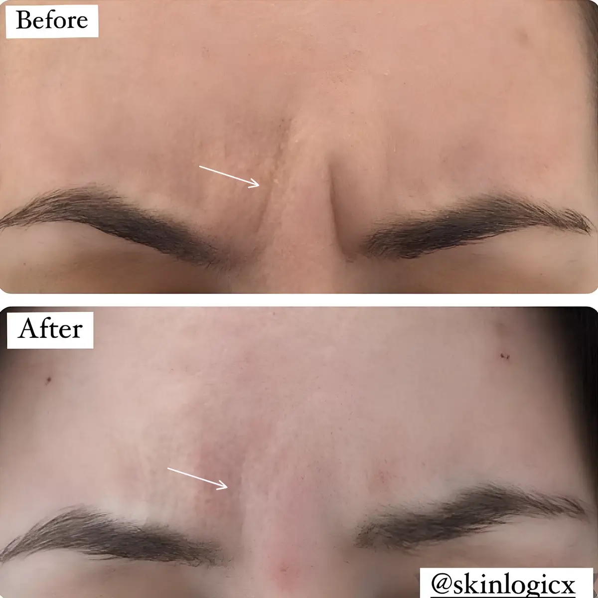 Botox Brow Lift Treatment Before and After from Skinlogicx in Rego Park, NY