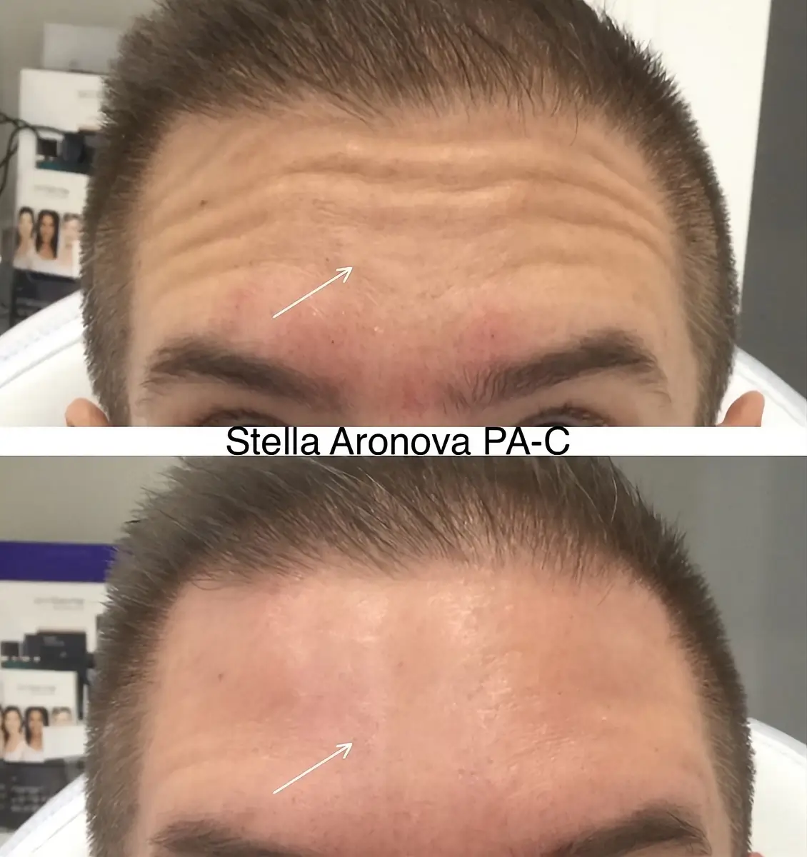 Botox Forehead Lift Treatment Before and After from Skinlogicx in Rego Park, NY