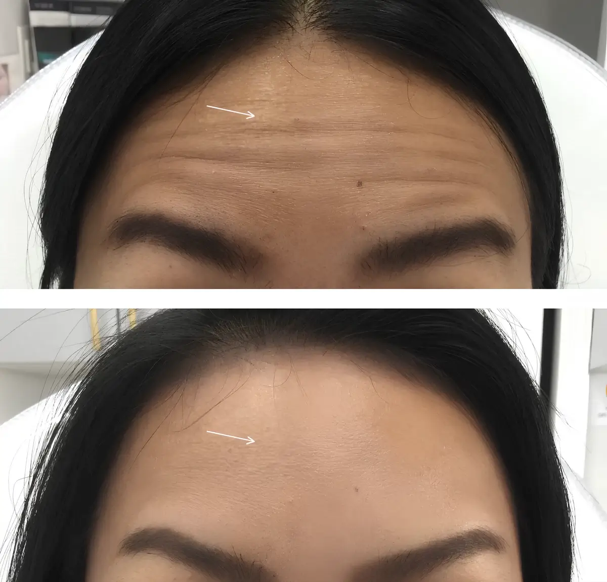 Botox Forehead Lift Treatment Before and After from Skinlogicx in Rego Park, NY