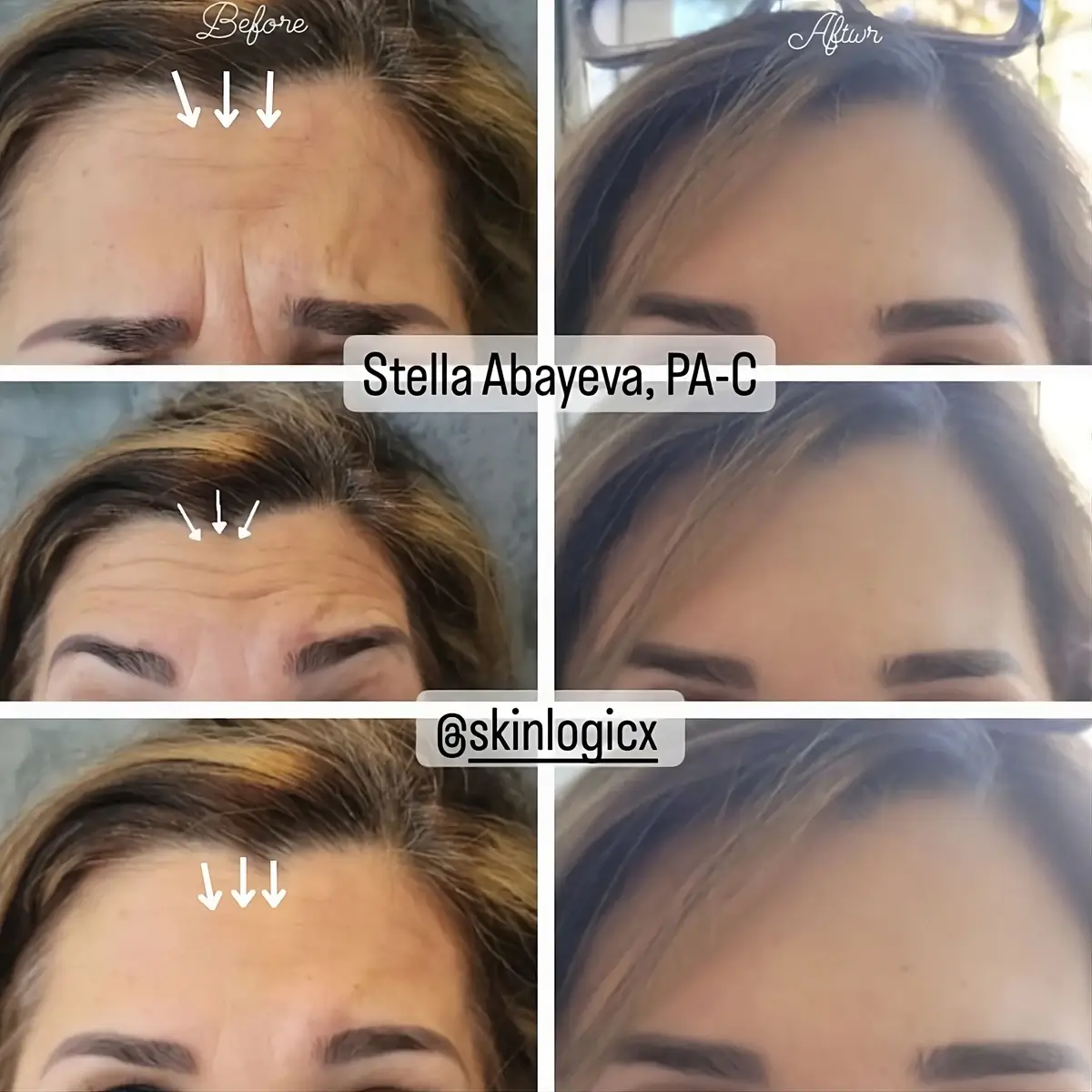 Botox Forehead Lift Treatment Before and After from Skinlogicx in Rego Park, NY