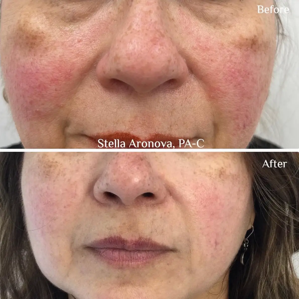 IPL Treatment Before and After from Skinlogicx in Rego Park, NY