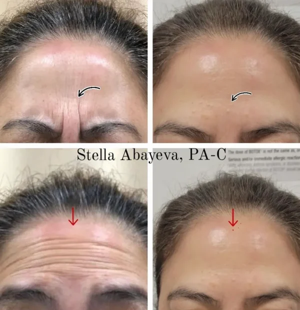 Botox Treatment | Before and After Photo | Skinlogicx | Rego Park, NY