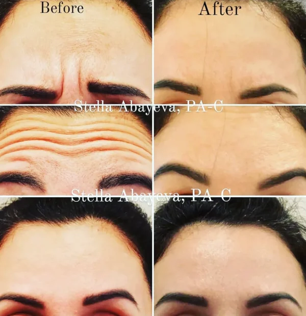 Botox | Forehead lines removal | Before and After Photo | Skinlogicx | Rego Park, NY