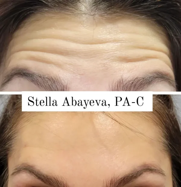 Botox Treatment for forehead lines | Before and After Photo | Skinlogicx | Rego Park, NY