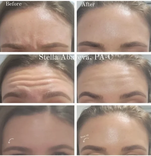 Botox Treatment in steps | Before and After Photo | Skinlogicx | Rego Park, NY