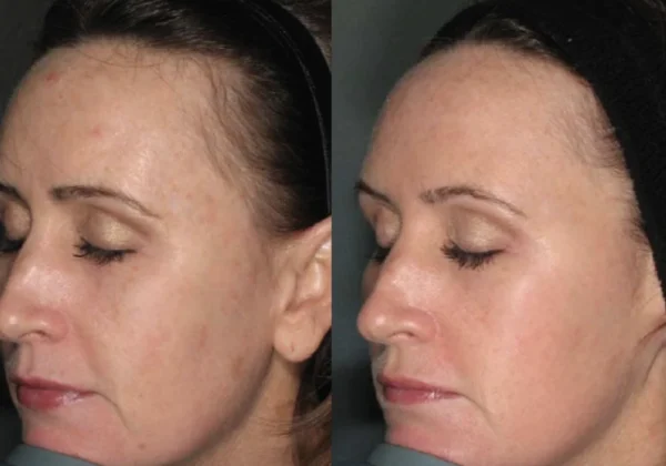 Clear Lift | Before and After Photo | Skinlogicx | Rego Park, NY