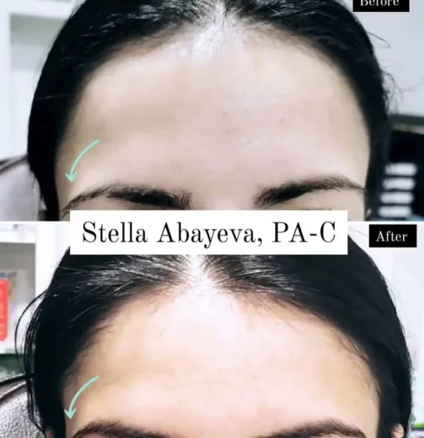 Eyebrow Lift | Before and After Photo | Skinlogicx | Rego Park, NY