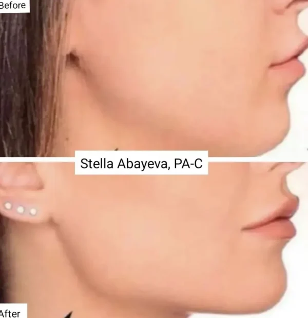 Kybella Treatment | Before and After Photo | Skinlogicx | Rego Park, NY