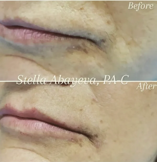 Nasolabial Line Correction | Before and After Photo | Skinlogicx | Rego Park, NY