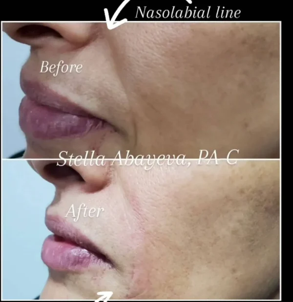 Nasolabial Line Before and After Photo | Skinlogicx | Rego Park, NY