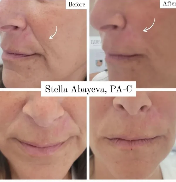 Nasolabial Line Correction Procedure | Before and After Photo | Skinlogicx | Rego Park, NY